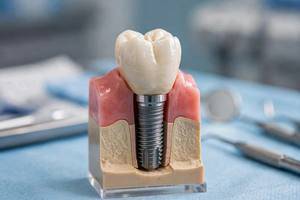 Implants